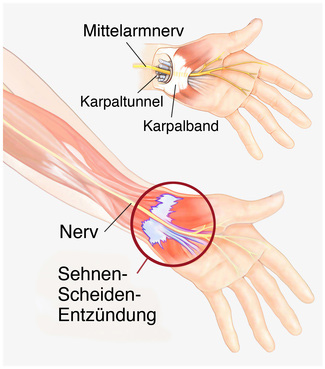 Karpaltunnelsyndrom: Symptome, Diagnose und Behandlung