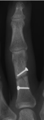 Ringfinger.jpg