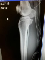 fibula1.jpg fibula1.jpg