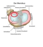 Meniskus_schmerzestelle.jpg Meniskus_schmerzestelle.jpg